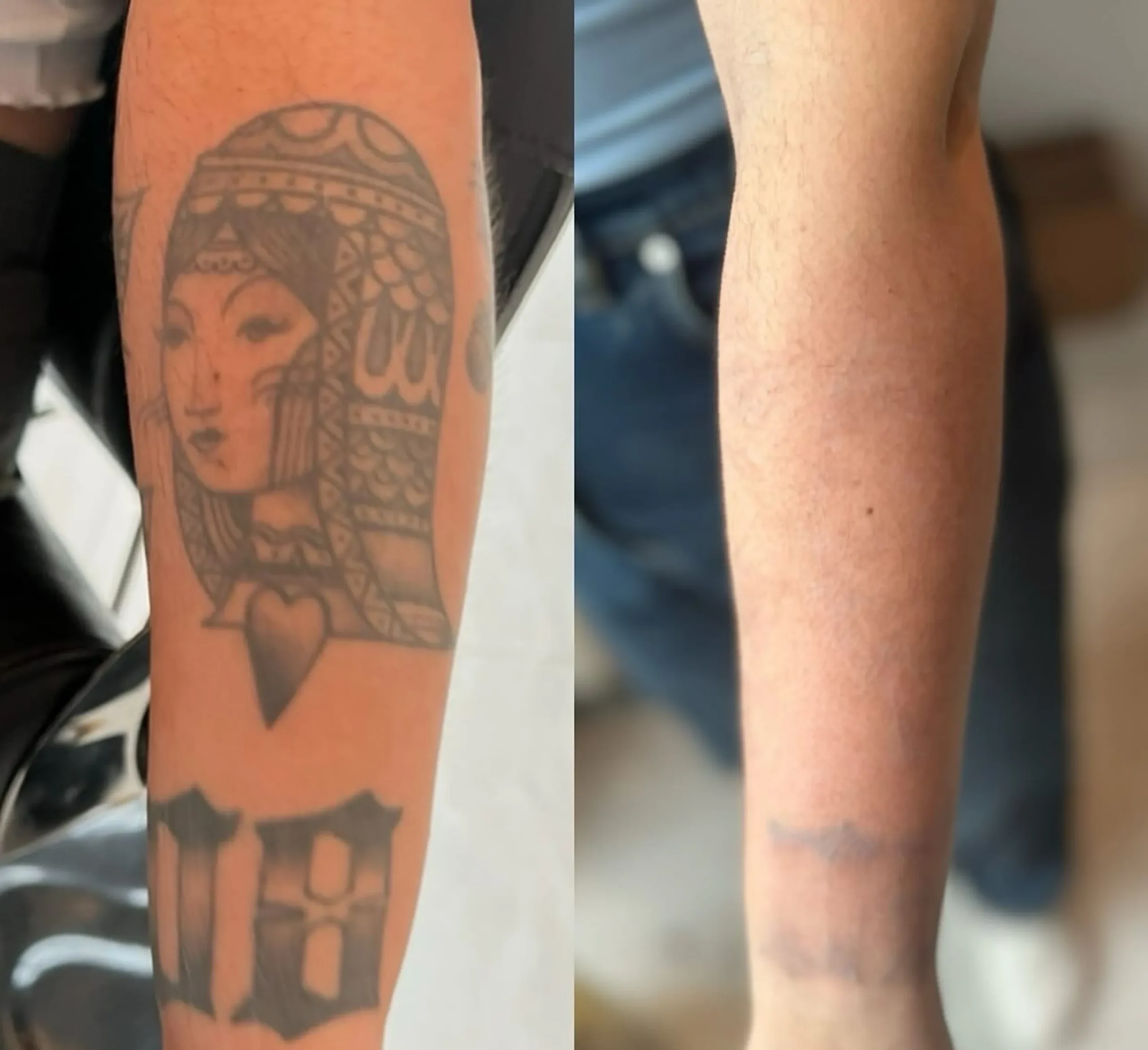 can you remove tattoo in summer