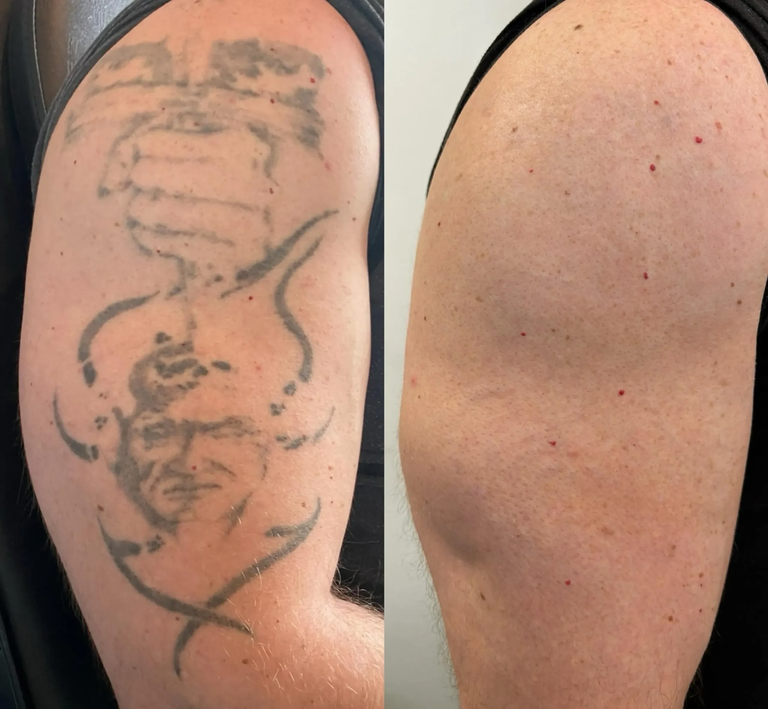 laser tattoo removal sun exposure
