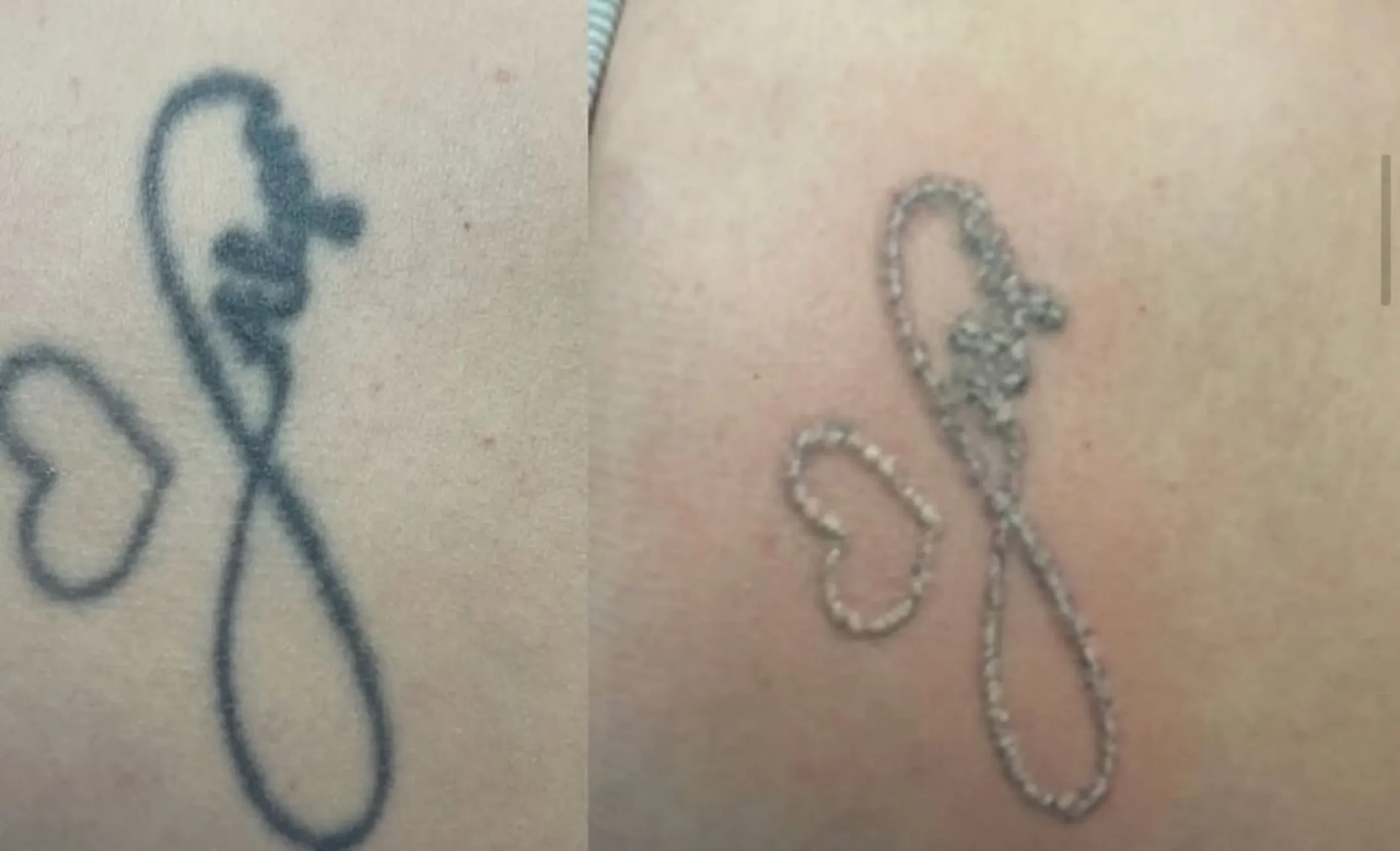 summer laser tattoo safety