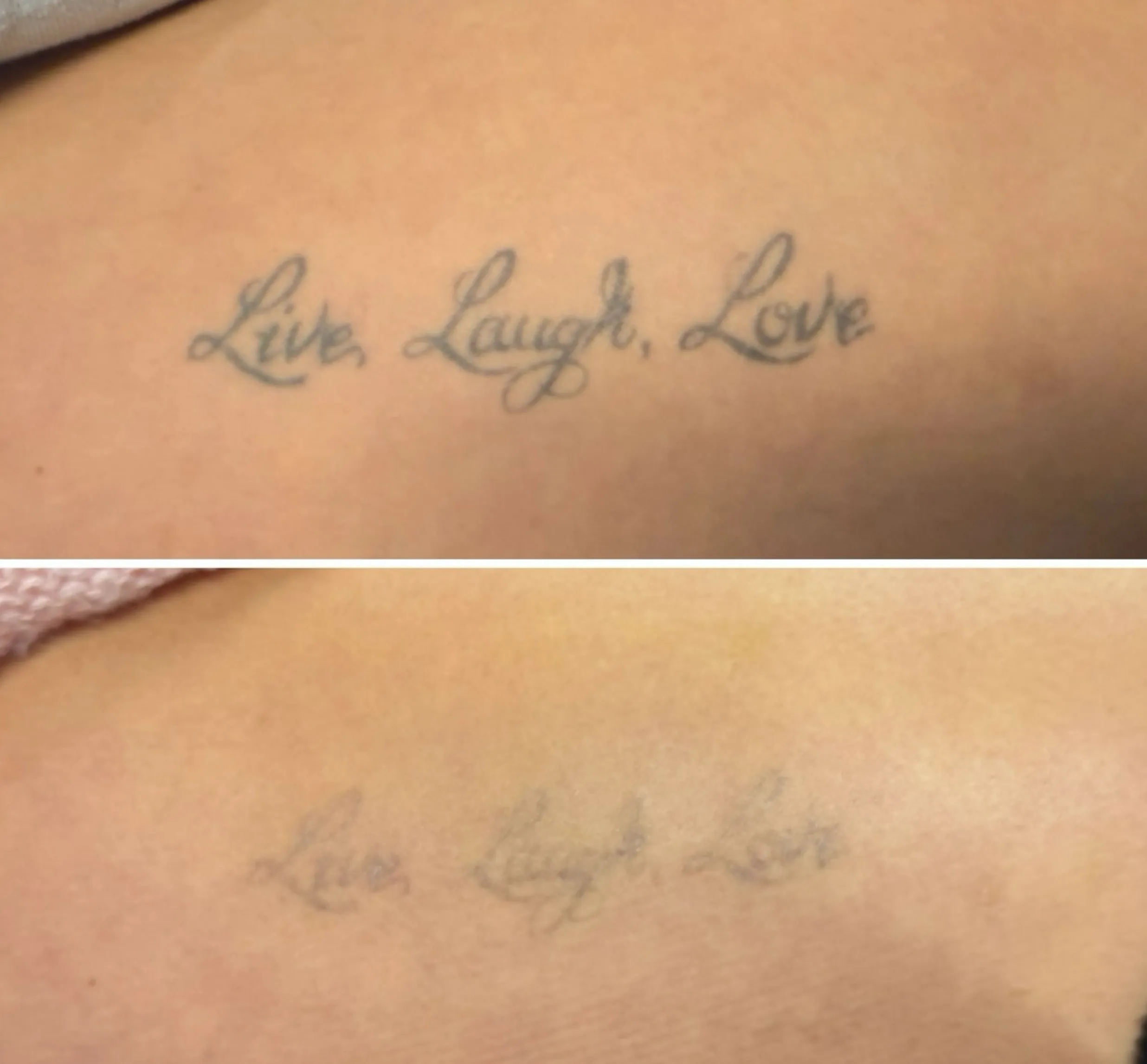 summer tattoo removal Melbourne