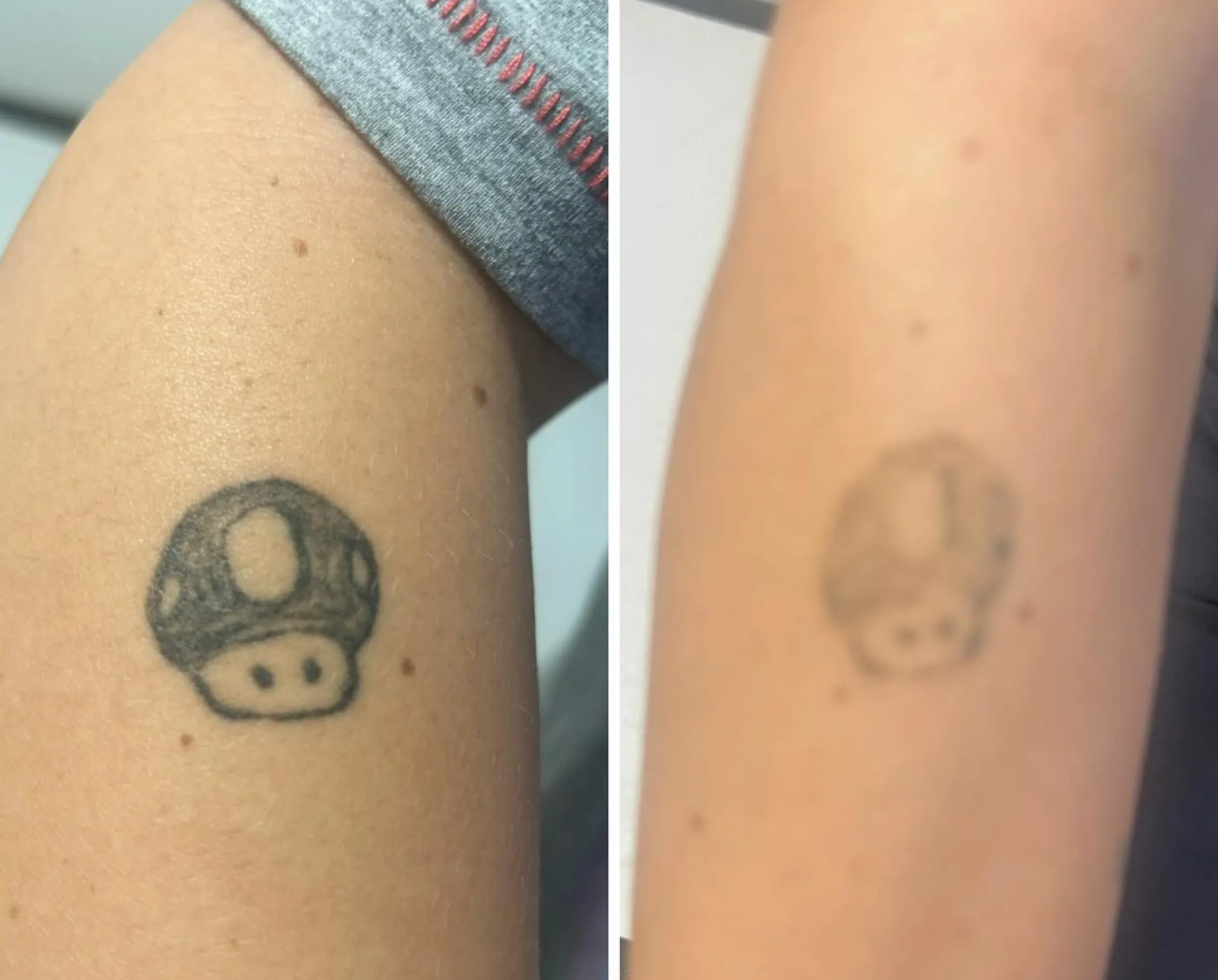 tattoo removal SPF aftercare