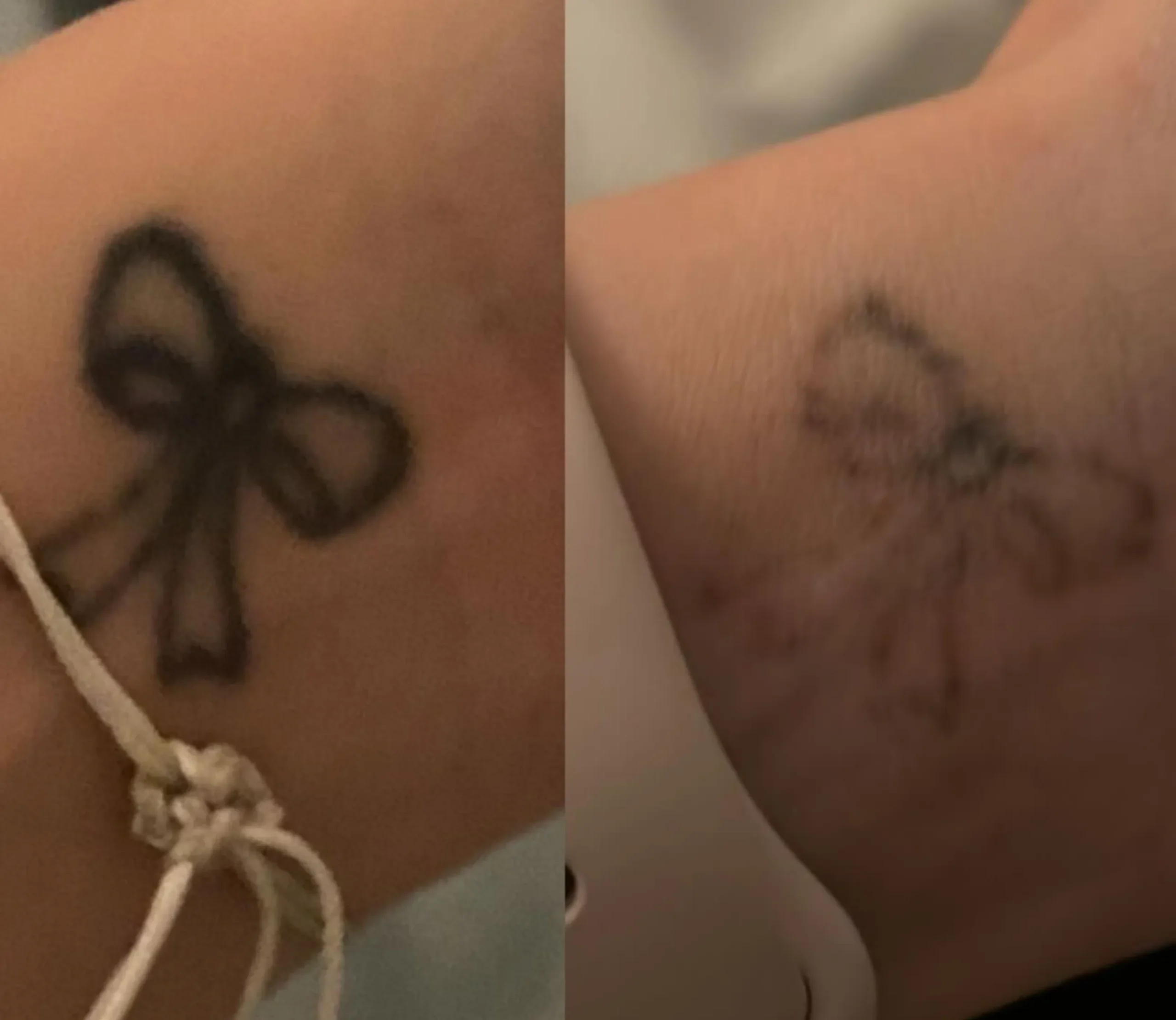 Can You Get Tattoo Removal In The Summer?