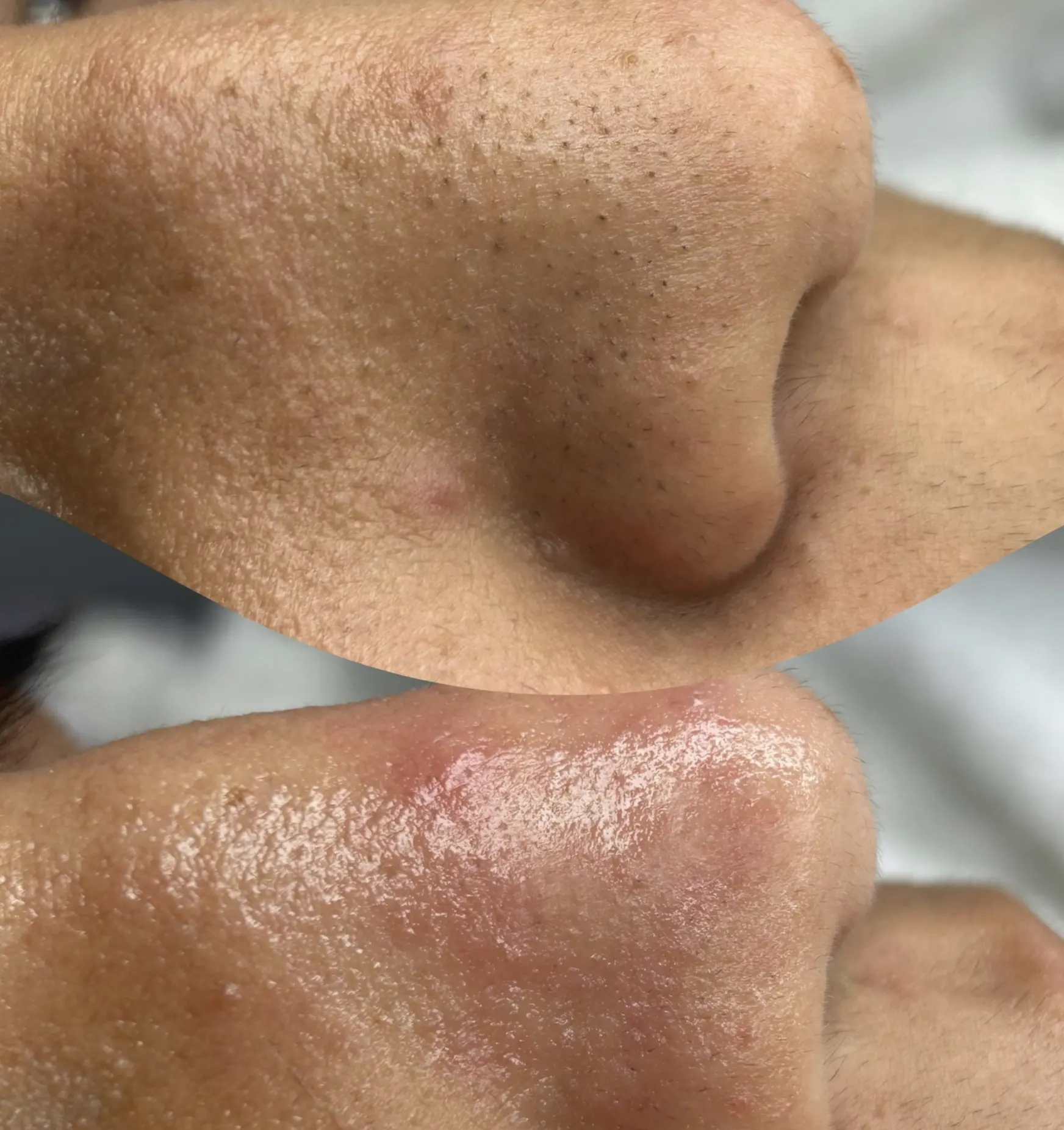 hydrafacial in Brisbane